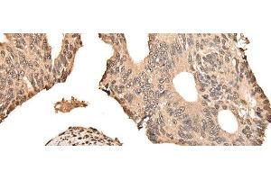 Immunohistochemistry of paraffin-embedded Human colorectal cancer tissue using ZSCAN12 Polyclonal Antibody at dilution of 1:50(x200) (ZSCAN12 Antikörper)