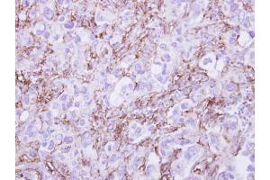 IHC-P Image G6PD antibody detects G6PD protein at cytosol on human breast cancer by immunohistochemical analysis. (Glucose-6-Phosphate Dehydrogenase Antikörper)