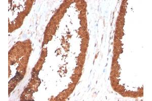 Formalin-fixed, paraffin-embedded human Prostate Carcinoma stained with TIGIT-Monospecific Mouse Monoclonal Antibody (TIGIT/3017).