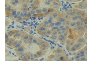 Detection of C2 in Human Liver cancer Tissue using Polyclonal Antibody to Complement Component 2 (C2) (Complement C2 Antikörper  (AA 245-451))