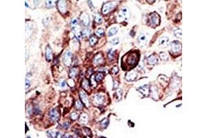 IHC analysis of FFPE human cancer tissue stained with the AXL antibody (AXL Antikörper  (AA 863-894))
