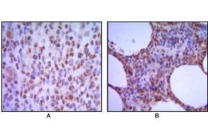Immunohistochemical analysis of paraffin-embedded human melanoma (A), non-Hodgkin`s lymphoma (B), using MUM1 antibody with DAB staining. (MUM1 Antikörper)