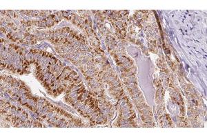 ABIN6267081 at 1/100 staining Human thyroid cancer tissue by IHC-P. (Connexin 43/GJA1 Antikörper  (pSer262))