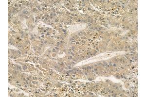 ABIN6262074 and ABIN6272312 at 1/100 staining human hepatocellular carcinoma by IHC-P. (GRAP Antikörper  (C-Term))
