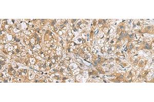 Immunohistochemistry of paraffin-embedded Human liver cancer tissue using DNPH1 Polyclonal Antibody at dilution of 1:60(x200)