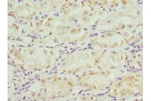Immunohistochemistry of paraffin-embedded human gastric cancer using ABIN7153264 at dilution of 1:100 (FGD5 Antikörper  (AA 1203-1462))