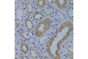 Immunohistochemistry of paraffin-embedded human kidney cancer using MVP Antibody (ABIN5971029) at dilution of 1/200 (40x lens). (MVP Antikörper)
