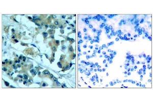 Immunohistochemical analysis of paraffin-embedded human lung carcinoma tissue, using MEK1 (Ab-217) antibody (E021203). (MEK1 Antikörper)