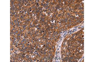Immunohistochemistry of Human colon cancer using CCDC106 Polyclonal Antibody at dilution of 1:60