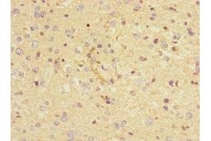Immunohistochemistry of paraffin-embedded human glioma using ABIN7161350 at dilution of 1:100