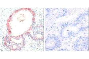 Immunohistochemistry analysis of paraffin-embedded human breast carcinoma, using Rel (Phospho-Ser503) Antibody.