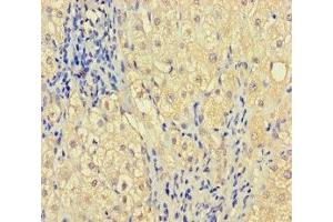 Immunohistochemistry of paraffin-embedded human liver cancer using ABIN7176291 at dilution of 1:100 (Zinc Finger Protein 44 Antikörper  (AA 1-300))