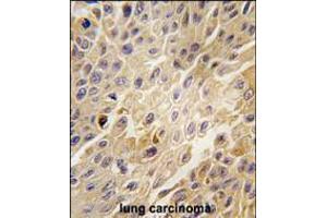 Formalin-fixed and paraffin-embedded human lung carcinoma tissue reacted with GRK2 Antibody , which was peroxidase-conjugated to the secondary antibody, followed by DAB staining. (GRK2 Antikörper  (C-Term))