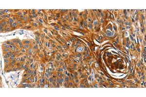 Immunohistochemistry of paraffin-embedded Human esophagus cancer tissue using AQP5 Polyclonal Antibody at dilution 1:40 (Aquaporin 5 Antikörper)