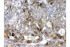 IHC testing of FFPE human liver cancer tissue with CYP2D6 antibody at 1ug/ml.