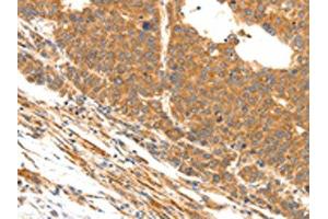 The image on the left is immunohistochemistry of paraffin-embedded Human liver cancer tissue using ABIN7190491(DOPEY1 Antibody) at dilution 1/25, on the right is treated with synthetic peptide. (DOPEY1 Antikörper)