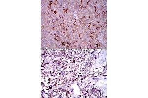 Immunohistochemical analysis of paraffin-embedded human ovarian cancer (upper) and human stomach cancer (bottom) tissues using G6PD monoclonal antibody, clone 5E12  with DAB staining. (Glucose-6-Phosphate Dehydrogenase Antikörper)