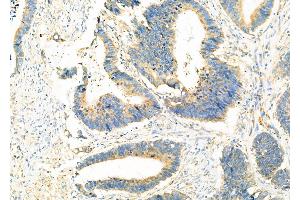 ABIN6265121 and ABIN6273320 at 1/100 staining Human colorectal cancer by IHC-P. (SLC25A46 Antikörper  (N-Term))