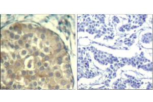 Immunohistochemical analysis of paraffin-embedded human breast carcinoma tissue using cofilin1/cofilin2 (phospho-Tyr88) Antibody (E011507). (Cofilin1/2 (CFL1/2) (pTyr88) Antikörper)