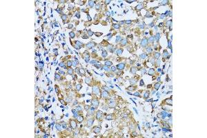 Immunohistochemistry of paraffin-embedded human lung cancer using OGDH antibody (ABIN5973793) at dilution of 1/100 (40x lens). (alpha KGDHC Antikörper)