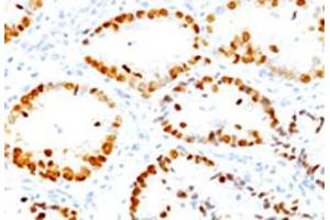 Immunohistochemical staining (Formalin-fixed paraffin-embedded sections) of human lung adenocarcinoma with NKX2-1 monoclonal antibody, clone SPM150 . (NKX2-1 Antikörper)