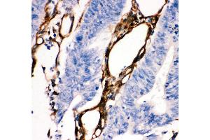 Anti- HSP27 antibody, IHC(P) IHC(P): Human Intestinal Cancer Tissue (HSP27 Antikörper  (AA 1-205))