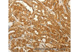 Immunohistochemistry of Human liver cancer using RAB35 Polyclonal Antibody at dilution of 1:50 (RAB35 Antikörper)