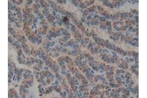 IHC-P analysis of Human Thyroid cancer Tissue, with DAB staining. (Biglycan Antikörper  (AA 48-158))
