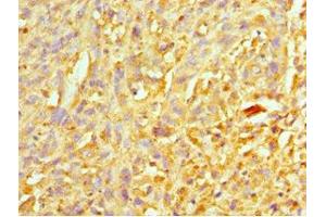 Immunohistochemistry of paraffin-embedded human melanoma using ABIN7151313 at dilution of 1:100 (XIAP Antikörper  (AA 1-200))