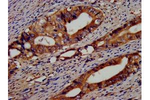 IHC image of ABIN7152156 diluted at 1:400 and staining in paraffin-embedded human colon cancer performed on a Leica BondTM system. (EIF3G Antikörper  (AA 2-320))