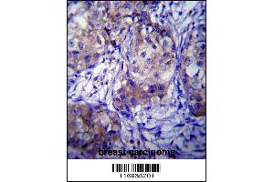 CYP1A1 Antibody immunohistochemistry analysis in formalin fixed and paraffin embedded human breast carcinoma followed by peroxidase conjugation of the secondary antibody and DAB staining. (CYP1A1 Antikörper  (AA 252-280))