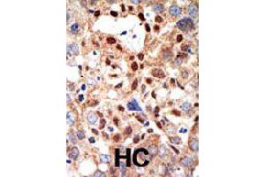 Formalin-fixed and paraffin-embedded human hepatocellular carcinoma tissue reacted with PML polyclonal antibody  , which was peroxidase-conjugated to the secondary antibody, followed by DAB staining . (PML Antikörper)