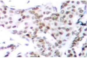 Immunohistochemistry (IHC) analyzes of p-STAT3 (pSer727) pAb in paraffin-embedded human breast carcinoma tissue. (STAT3 Antikörper  (pSer727))