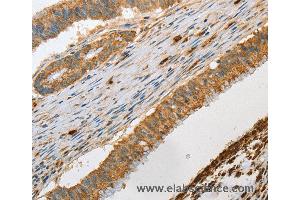 Immunohistochemistry of Human colon cancer using GZMB Polyclonal Antibody at dilution of 1:30 (GZMB Antikörper)