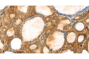 Immunohistochemistry of paraffin-embedded Human thyroid cancer using TMPRSS11F Polyclonal Antibody at dilution of 1:30 (TMPRSS11F Antikörper)