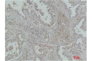 Immunohistochemistry (IHC) analysis of paraffin-embedded Human Lung Carcinoma using MICU1 Monoclonal Antibody. (MICU1 Antikörper)