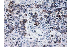Immunohistochemical staining of paraffin-embedded Carcinoma of Human lung tissue using anti-PDE4B mouse monoclonal antibody. (PDE4B Antikörper)