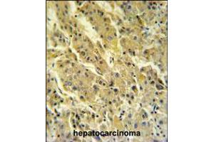 PSG7 Antibody IHC analysis in formalin fixed and paraffin embedded hepatocarcinoma followed by peroxidase conjugation of the secondary antibody and DAB staining. (PSG7 Antikörper  (C-Term))