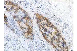 ABIN6264918 and ABIN6277937 at 1/100 staining human pancreatic carcinoma by IHC-P. (SALL4 Antikörper  (Internal Region))