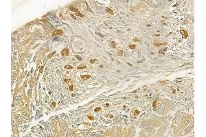 ABIN6258755 and ABIN6273696 at 1/100 staining human tongue carcinoma by IHC-P.