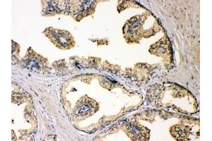 IHC testing of FFPE human prostate cancer with DBI antibody at 1ug/ml. (Diazepam Binding Inhibitor Antikörper  (AA 2-187))