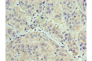 Immunohistochemistry of paraffin-embedded human liver cancer using ABIN7153848 at dilution of 1:100 (GAN Antikörper  (AA 1-240))