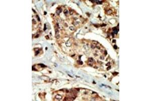 Formalin-fixed and paraffin-embedded human cancer tissue (breast carcinoma) reacted with the primary antibody, which was peroxidase-conjugated to the secondary antibody, followed by DAB staining. (STK16 Antikörper  (N-Term))