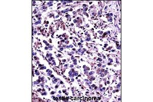 CN11 Antibody (Center) (13870c)immunohistochemistry analysis in formalin fixed and paraffin embedded human testis carcinoma followed by peroxidase conjugation of the secondary antibody and DAB staining. (CAPN11 Antikörper  (AA 409-438))