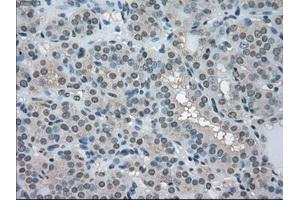 Immunohistochemical staining of paraffin-embedded Carcinoma of pancreas tissue using anti-LDHAmouse monoclonal antibody. (Lactate Dehydrogenase A Antikörper)