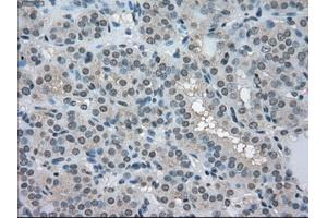 Immunohistochemical staining of paraffin-embedded Carcinoma of pancreas tissue using anti-LDHAmouse monoclonal antibody.