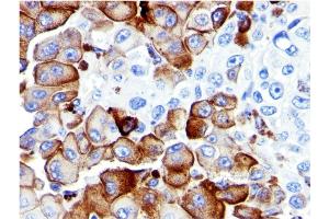 Formalin-fixed, paraffin-embedded human Melanoma stained with NGFR Mouse Monoclonal Antibody (NGFR5). (NGFR Antikörper)