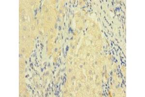 Immunohistochemistry of paraffin-embedded human liver cancer using ABIN7173813 at dilution of 1:100 (FASL Antikörper  (AA 103-281))