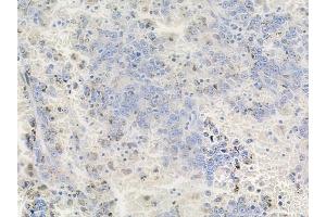ABIN6256494 and ABIN6267663 at 1/100 staining human melanoma by IHC-P.