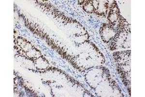 IHC-P: MCM2 antibody testing of human intestinal cancer tissue (MCM2 Antikörper  (C-Term))